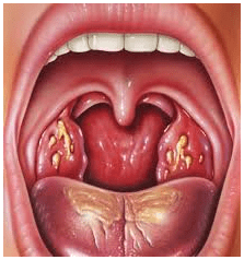 Amigdalitis